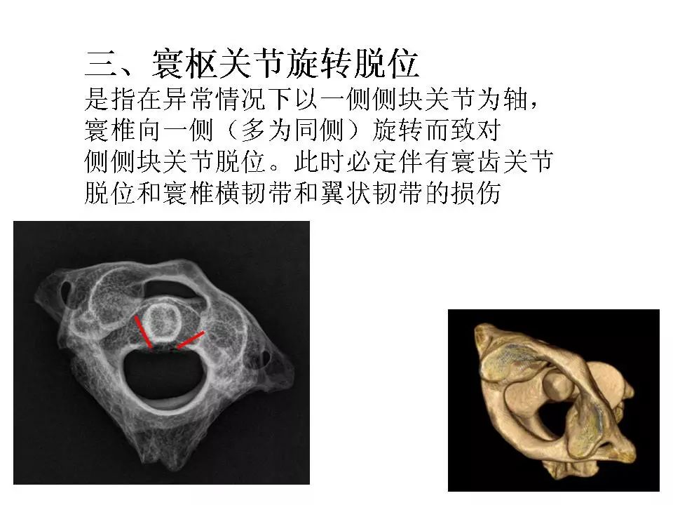 寰枢关节脱位的影像诊断