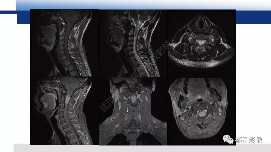 脊髓髓内神经鞘瘤影像诊断