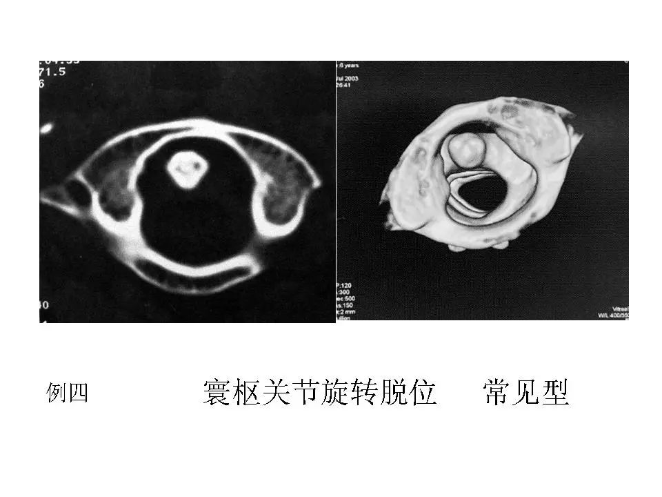 寰枢关节脱位的影像诊断