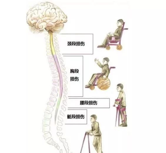 脊髓损伤的康复