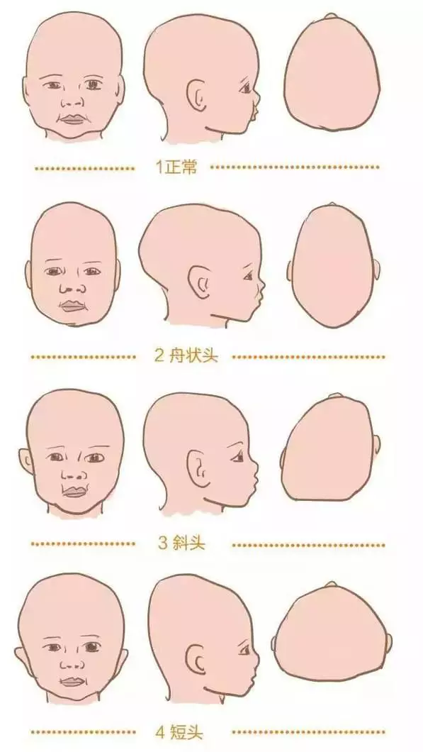 扁头综合征常见头型