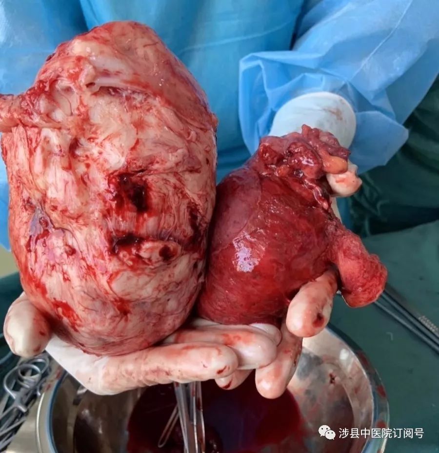 【病例分享】 涉县中医院妇产科巨大子宫肌瘤切除术记实
