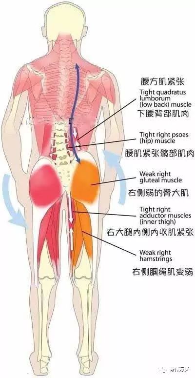 腰方肌 脊柱侧翻弯