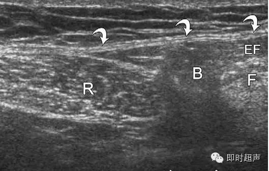 对腹股沟疝最全面的超声诊断有图有病例