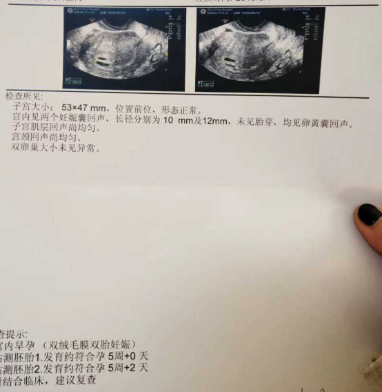 原创孕妈刚测出怀孕,肚子疼痛强烈,本以为是宫外孕,产检却怀的双胞胎