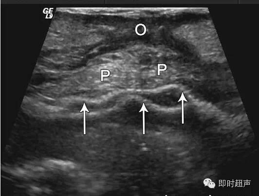 对腹股沟疝最全面的超声诊断有图有病例