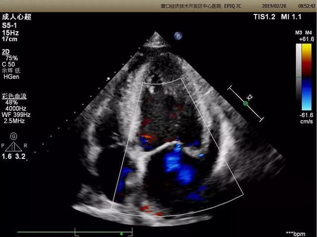 心 脏 心脏三维超声成像 能够整体,直观的获得心脏内部结构图像,医生