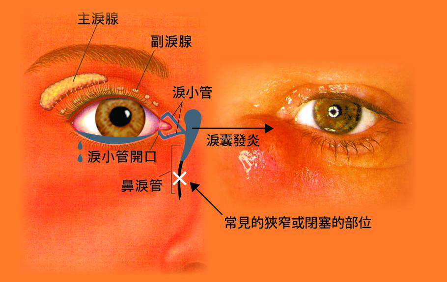 泪水是由眼皮下隐藏的泪腺分泌所产生,经过 泪小点,泪小管,泪囊后再由