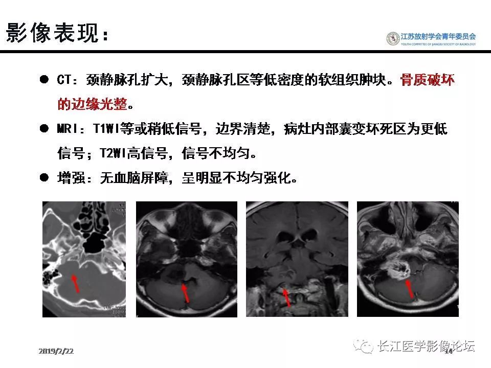 头颈部颈静脉孔神经鞘瘤