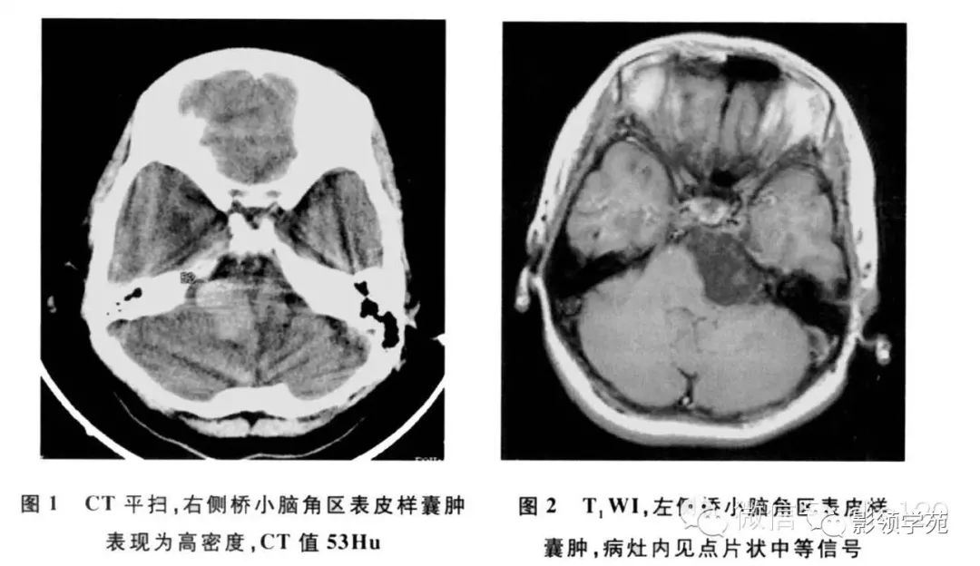 脉络膜裂囊肿的影像学表现及鉴别诊断