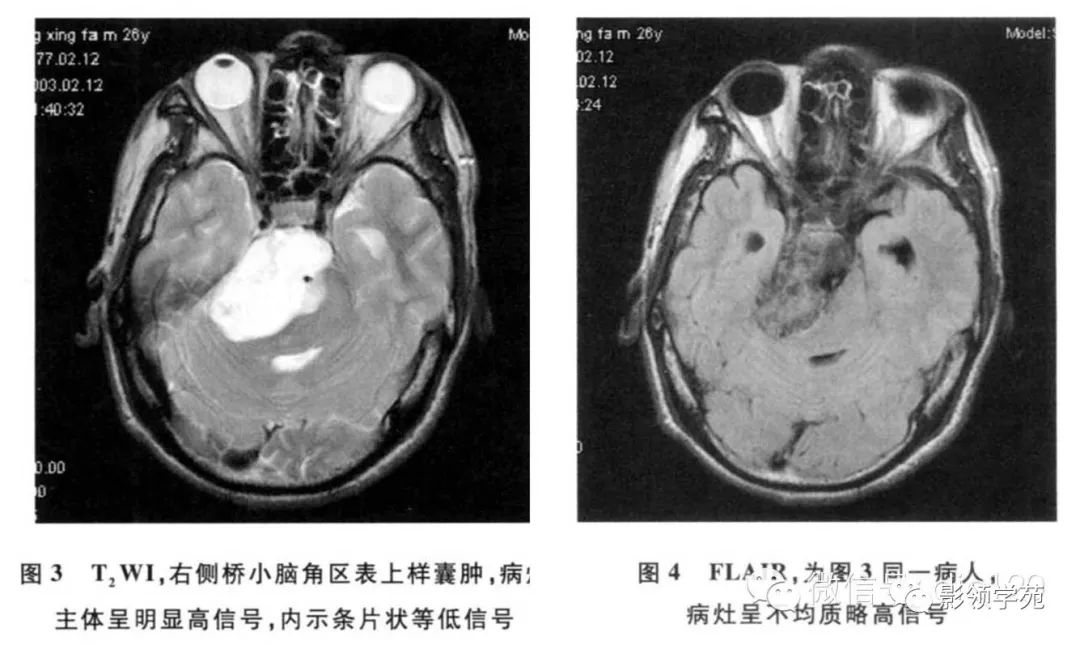 脉络膜裂囊肿的影像学表现及鉴别诊断