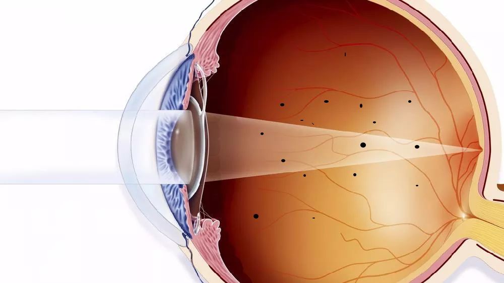 近视的人眼前总有 "蚊子"飞,是眼睛出了啥问题?_玻璃体