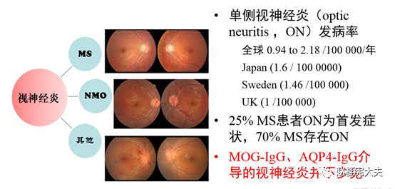 一项前瞻性研究 血清mog抗体阳性的视神经炎的特点 临床