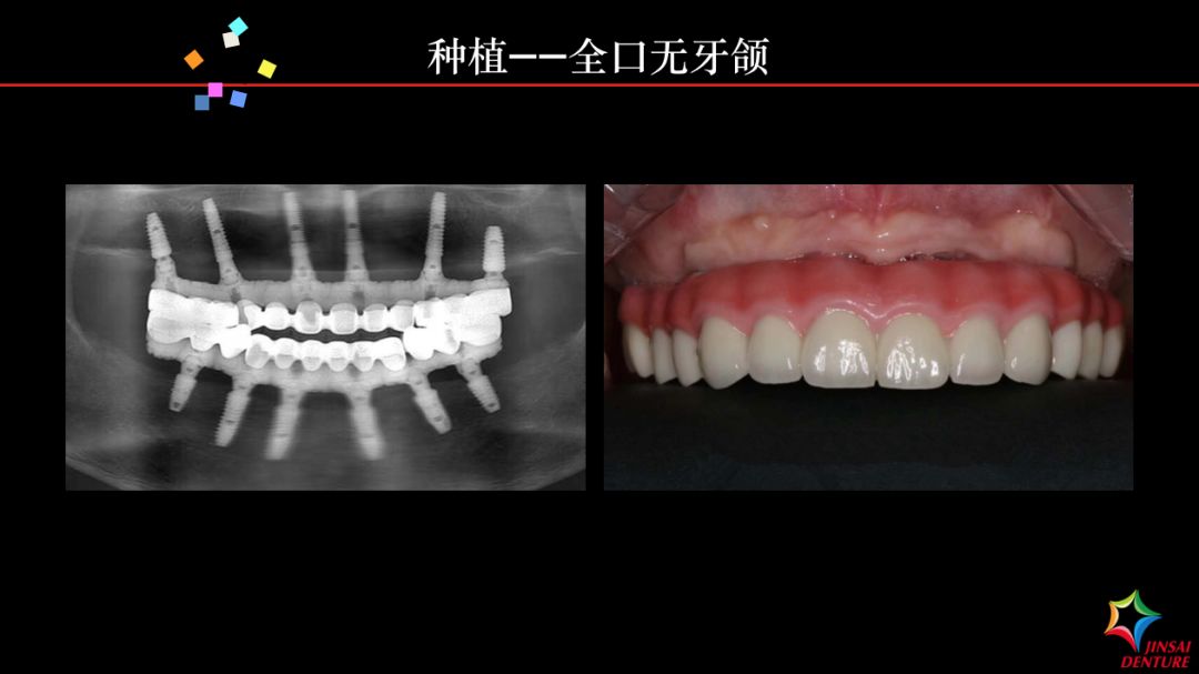 金赛义齿种植马龙桥修复病例