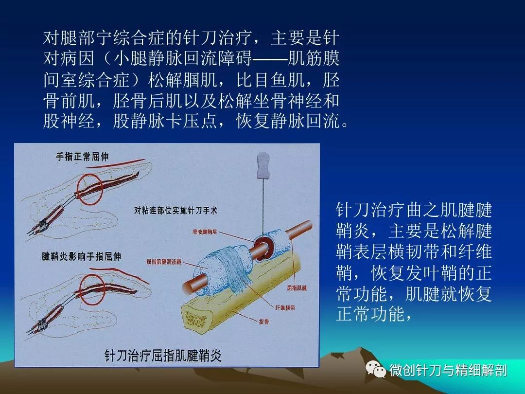 针刀松解减压术在疼痛科的应用