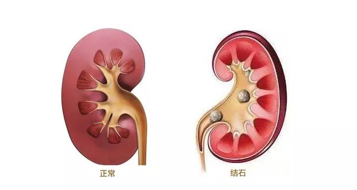 体检查出肾结石怎么办预防肾结石早期谨记一少三勤4字秘诀