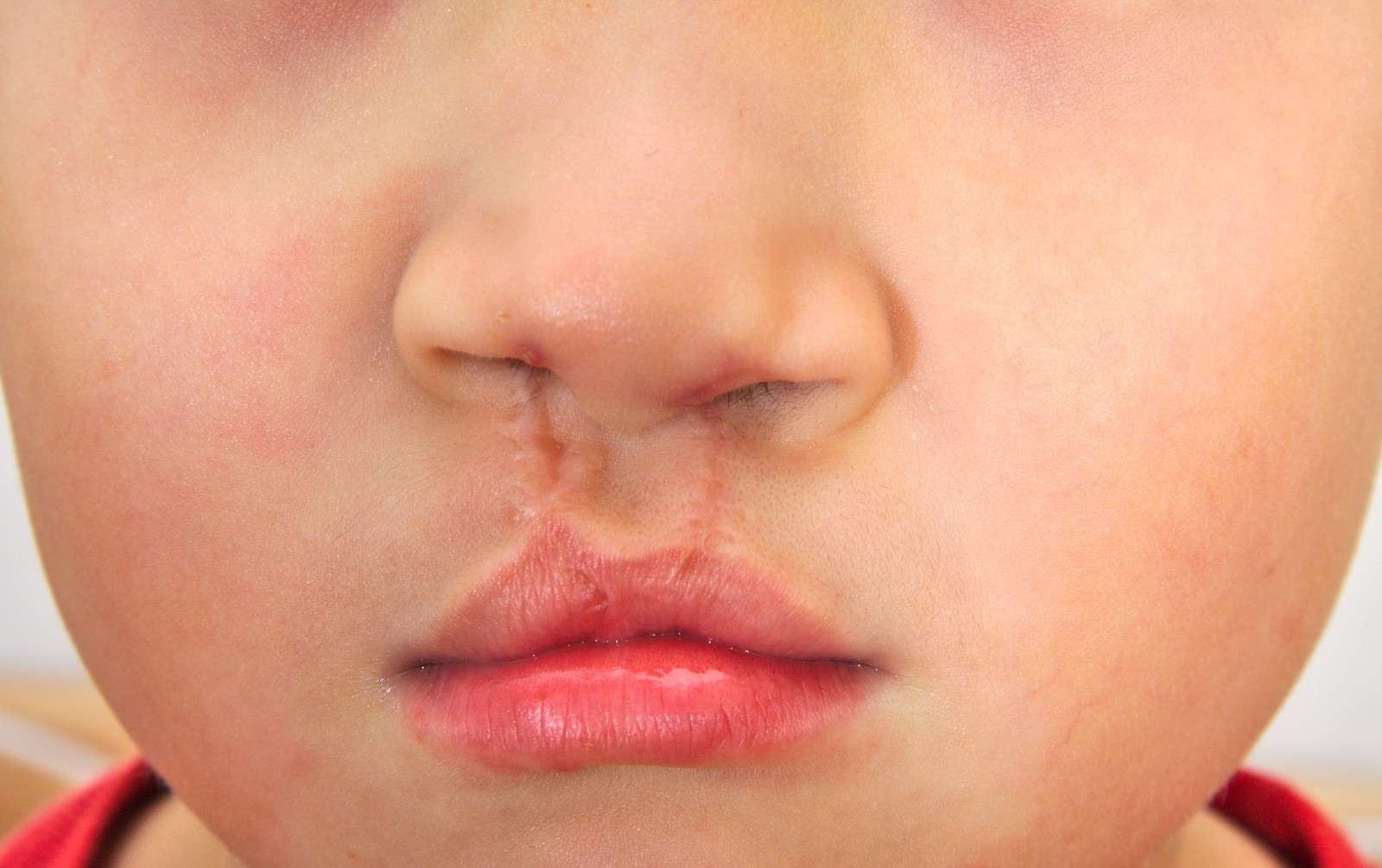 【案例分析】唇裂患者鼻孔一大一小不美观，想做手术修复-余文林副主任医师-爱问医生