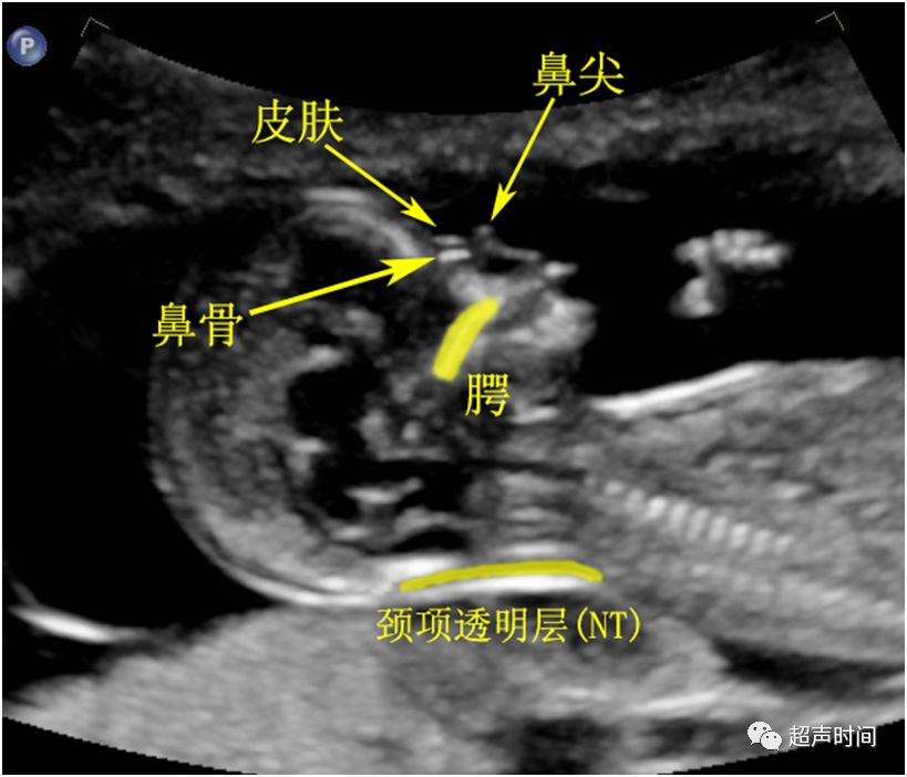 胎儿正中矢状切面,显示三条高回声线:皮肤,鼻骨,鼻尖