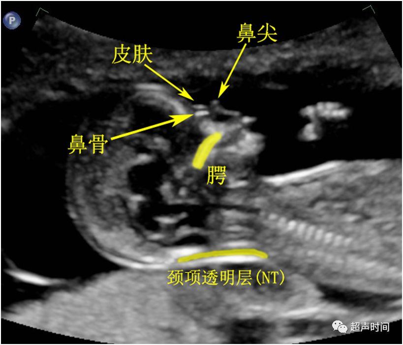 孕早期超声扫查规范fmf版鼻骨与颌面角