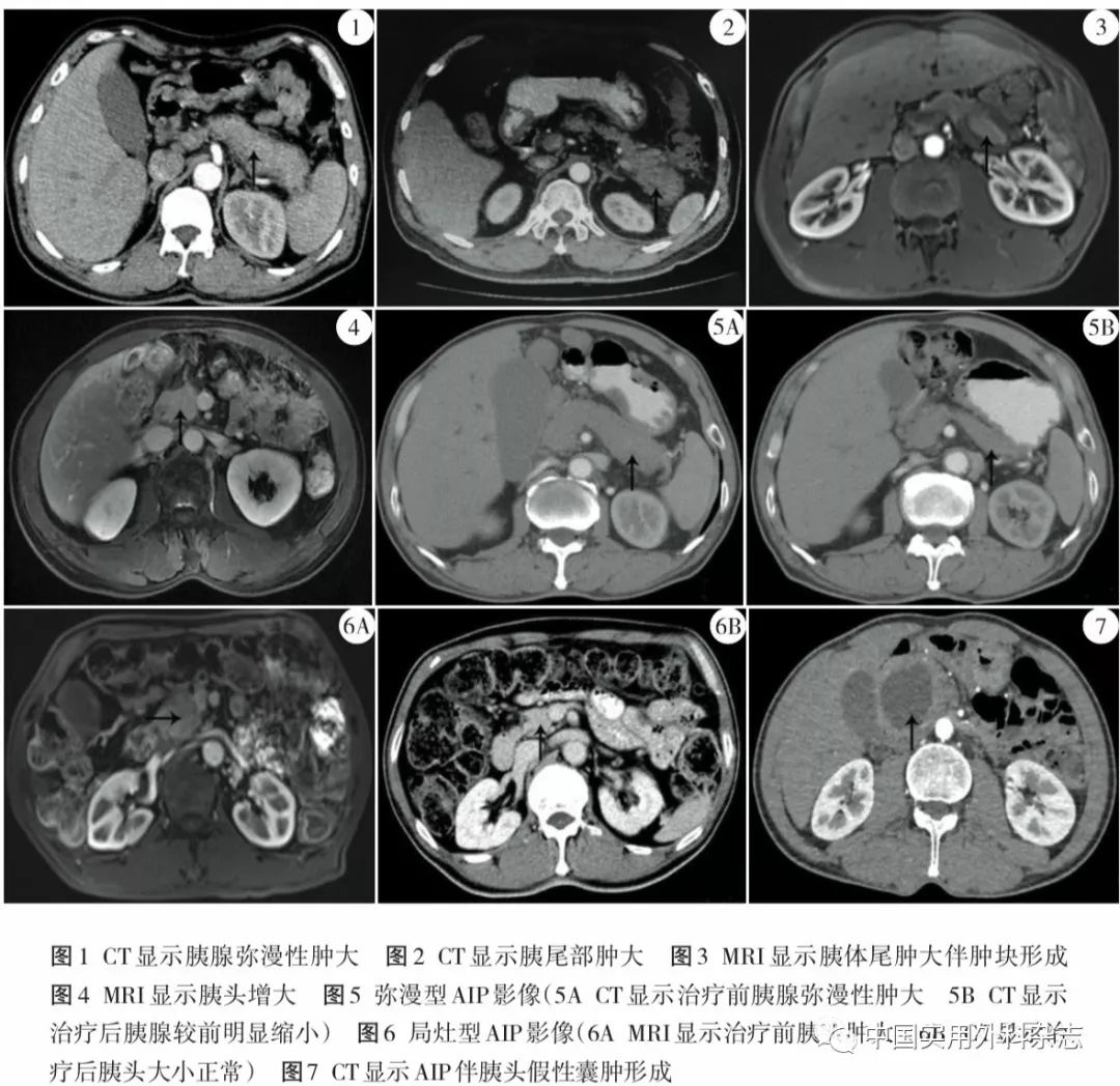 3 影像学检查 所有17例病人均行胰腺ct平扫 增强检查,9例行胰腺mr平扫