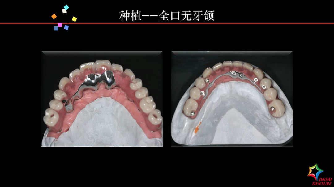 金赛义齿种植马龙桥修复病例