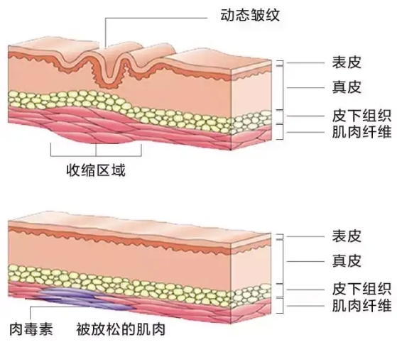 去皱针什么原理_打去皱针初期吓人图片