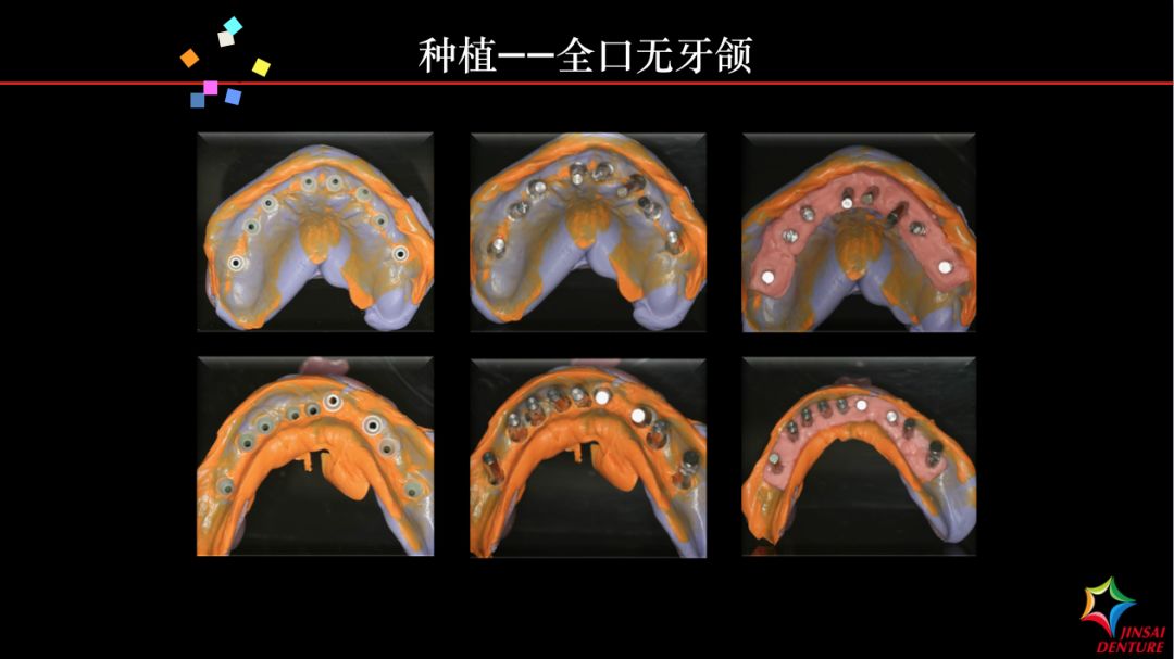 金赛义齿种植马龙桥修复病例