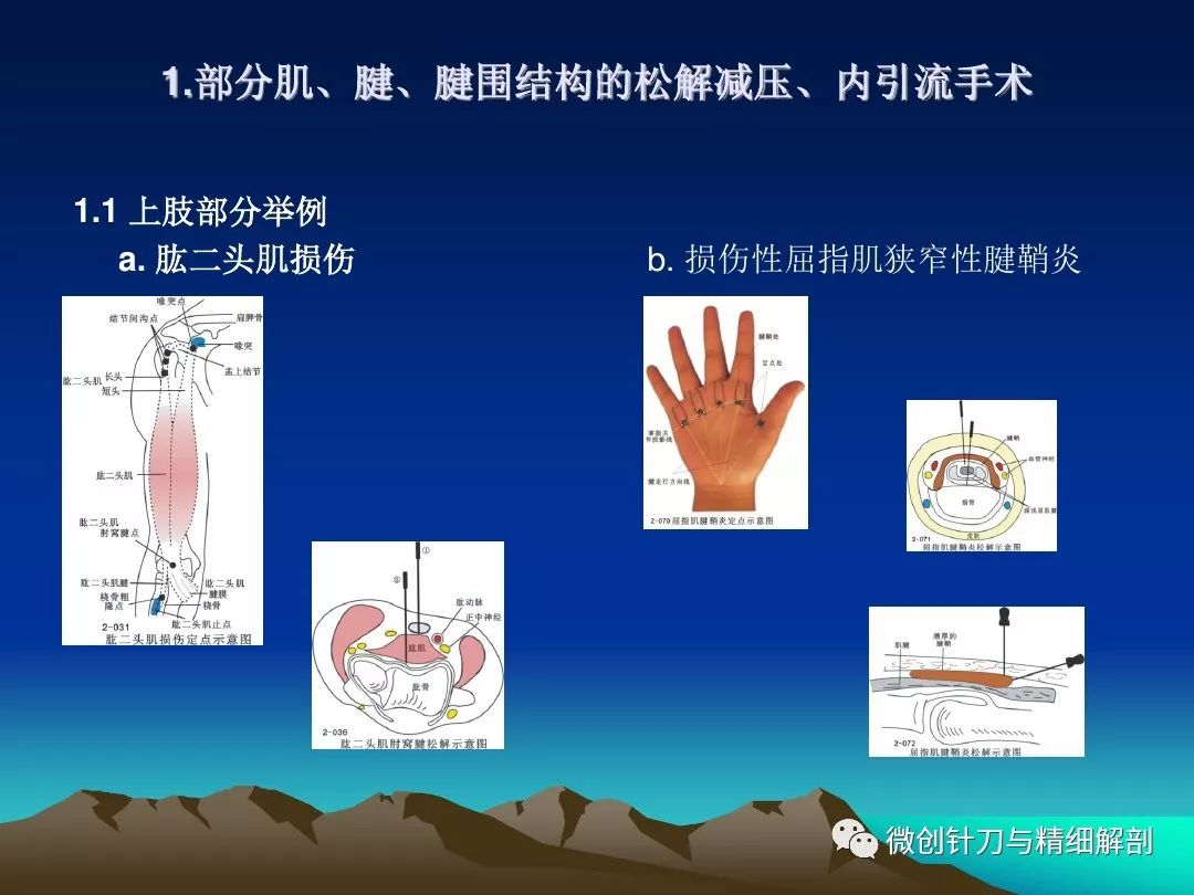 针刀松解减压术在疼痛科的应用