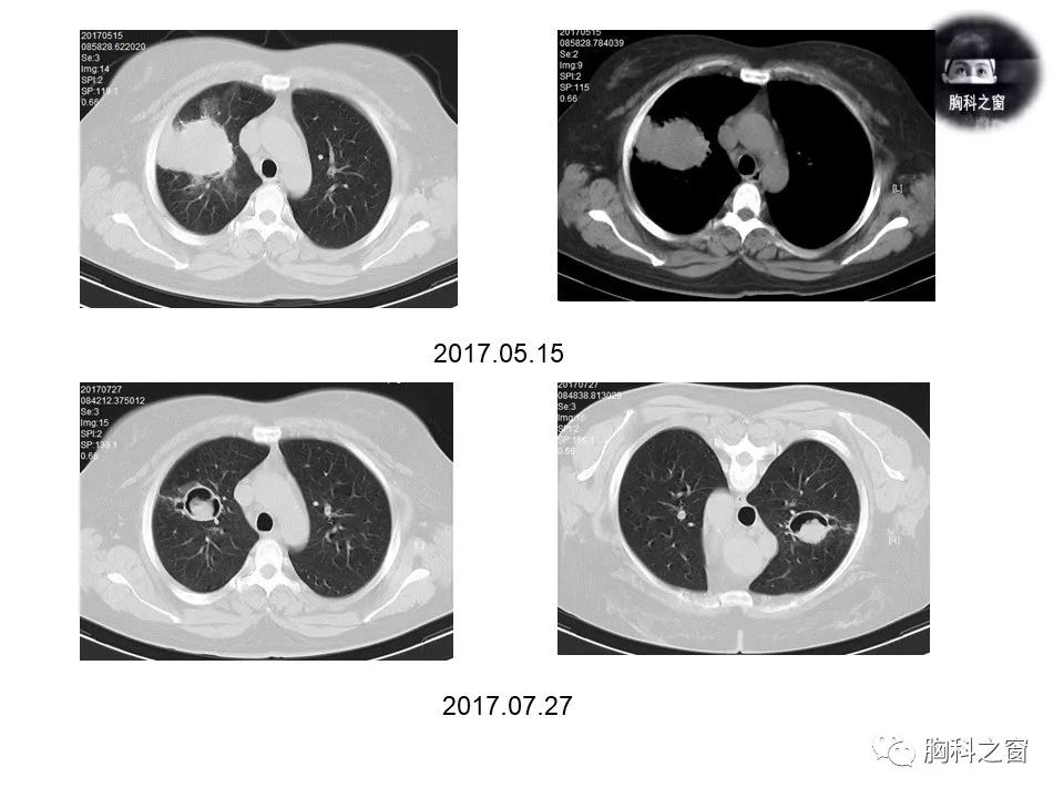 一般不累及肺实质,没有或很少出现血管浸润和凝固性坏死