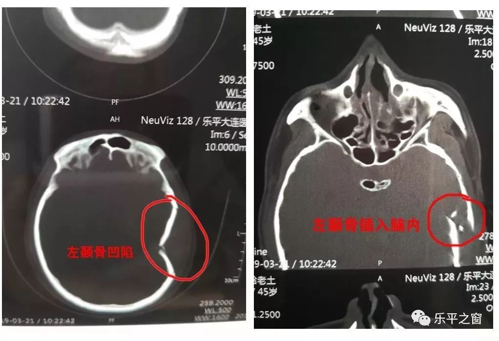 面部多处见血凝斑,行头部ct检查示"左颞骨凹陷性骨折伴左侧脑挫裂伤"