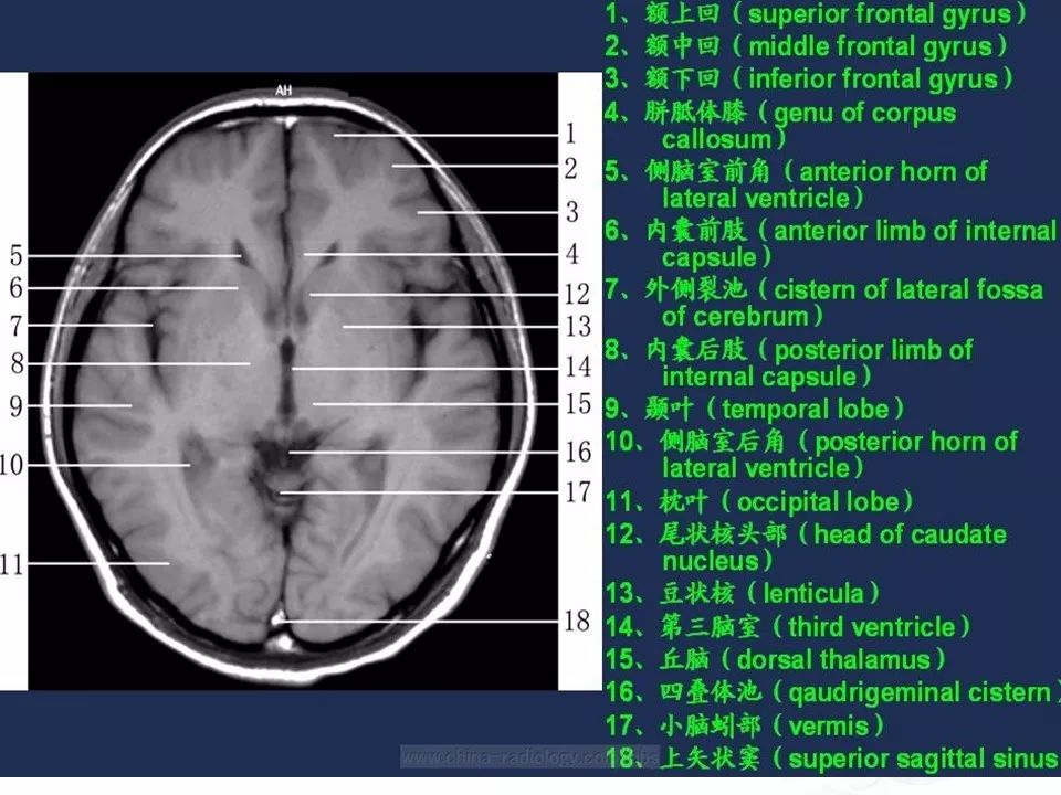 过目不忘肾上腺脑白质营养不良特征影像表现