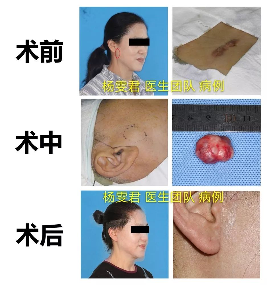 杨雯君教授:腮腺肿瘤手术,可以做到不留疤吗?