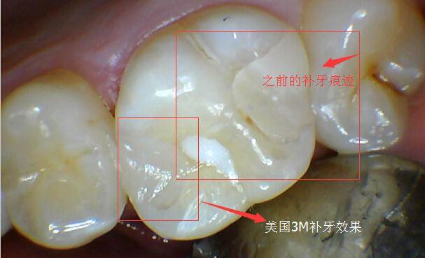 补牙的材料:现在的补牙材料比过去好多了,以前都是银汞或玻璃离子