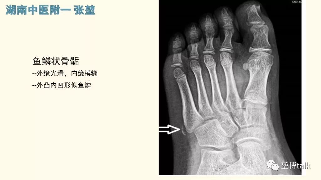 第五跖骨基底骨折——你真的懂吗?