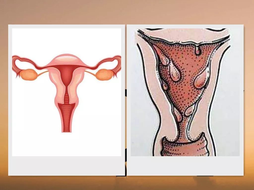 子宫内膜正常是光滑的,而子宫内膜息肉,就像是附着在内膜上的果子