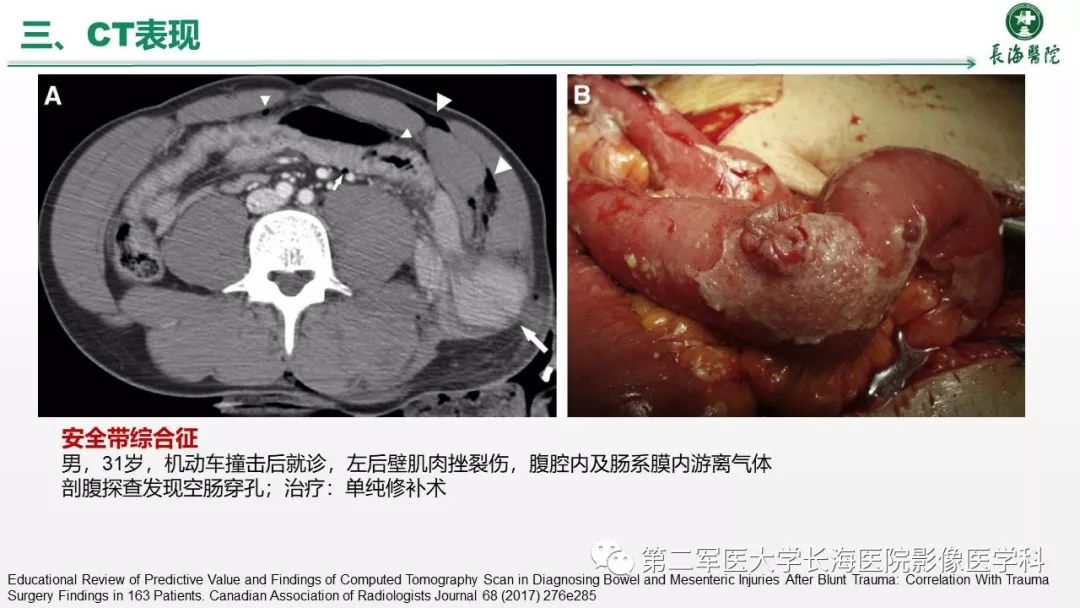 肠道及肠系膜钝挫伤ct表现具有高特异性,低敏感性,延误诊断可能对