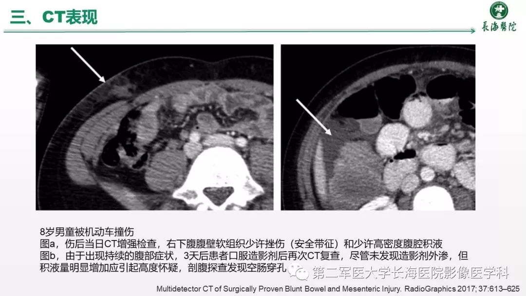 肠道及肠系膜钝挫伤ct表现具有高特异性,低敏感性,延误诊断可能对