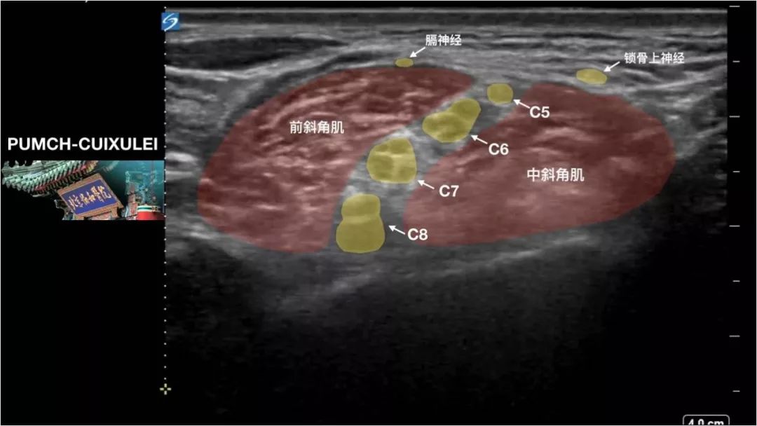 【神经阻滞第二弹】超声引导臂丛神经阻滞(上篇)
