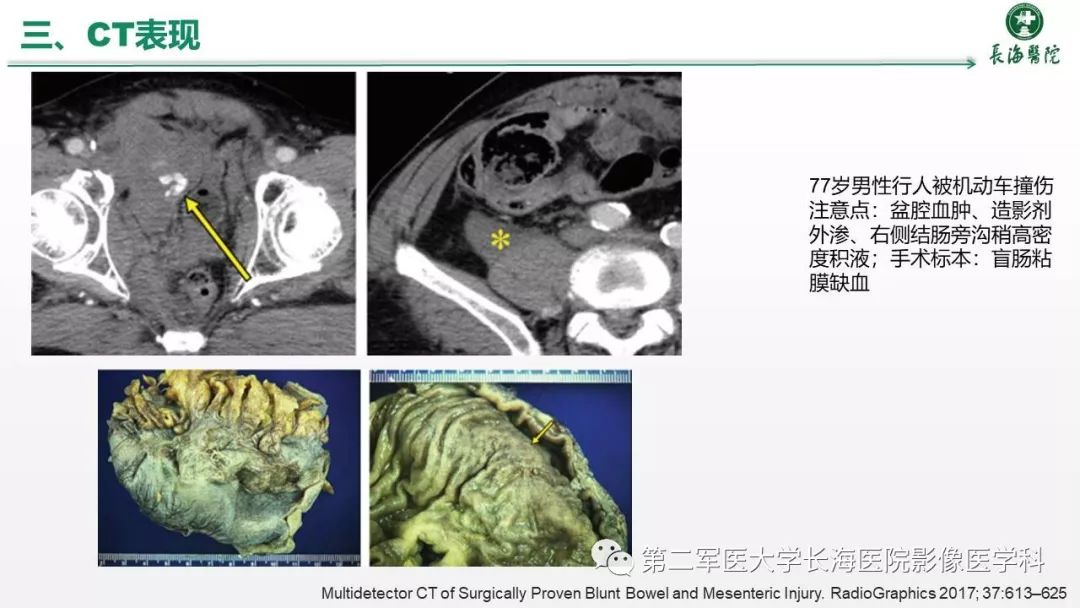 肠道及肠系膜钝挫伤ct表现具有高特异性,低敏感性,延误诊断可能对