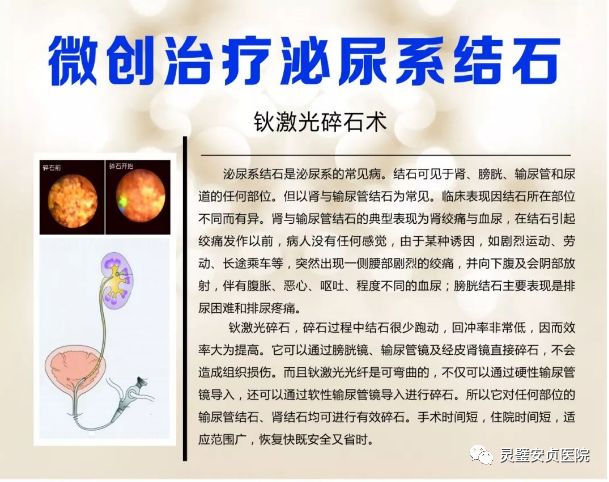 重磅消息快微创灵璧安贞医院碎石神器钬激光碎石系统投入使用30分钟击