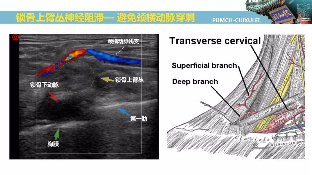 神经阻滞第二弹超声引导臂丛神经阻滞上篇