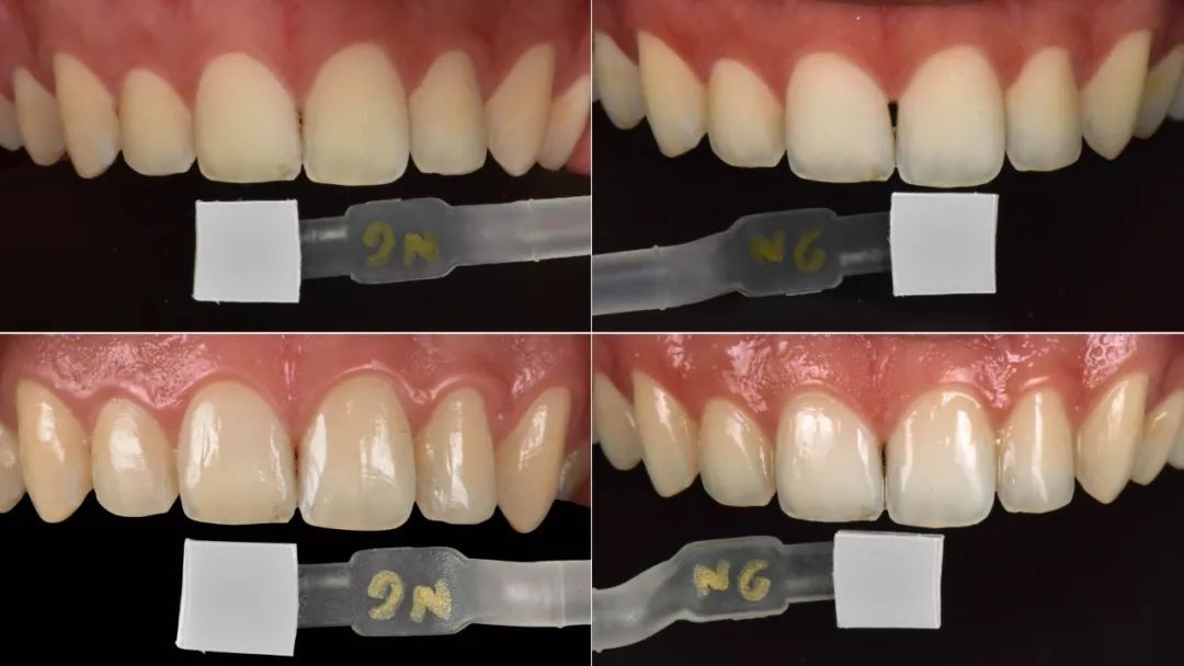 病例分享牙齿外漂白