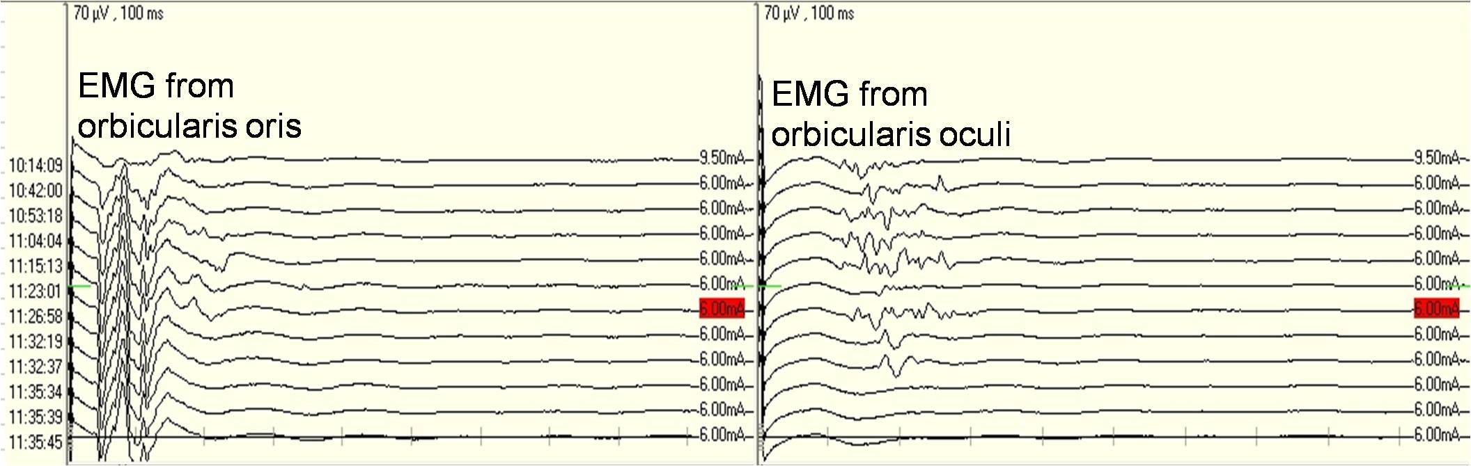 左侧口轮匝肌及眼轮匝肌肌电,术中分离责任血管与神经后,眼轮匝肌肌电