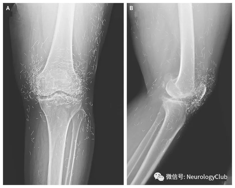 (图4:骨关节炎患者,金线针刺治疗后的双手平片膝盖平片)