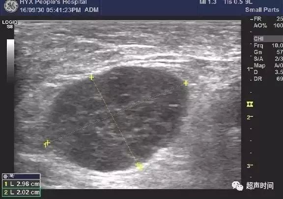 超声高手进阶9个病例学会诊断淋巴瘤