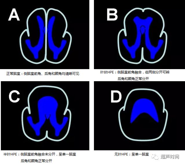 前脑无裂畸形多图文超声解析