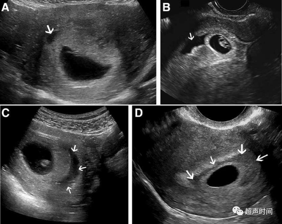 孕早期绒毛膜下血肿:超声评估方法和预后
