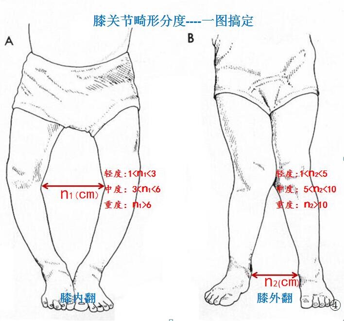 一图教你识别膝关节是内翻(o型腿)还是外翻(x型腿)