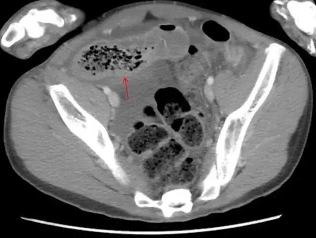 11岁儿童腹内粪石堵死肠道,病发前曾空腹吃大量芒果绿豆饼