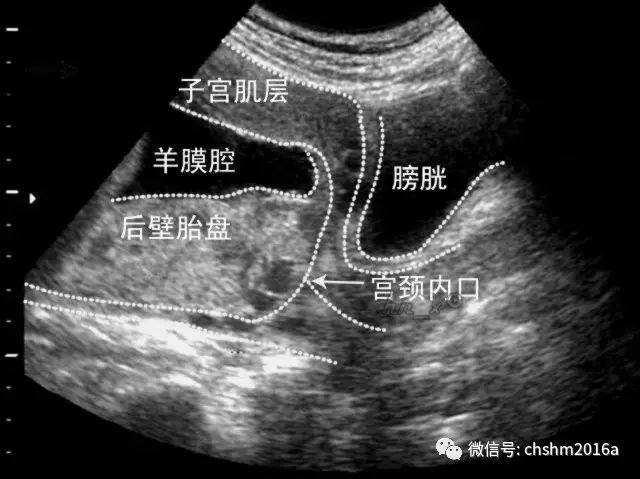 高度警惕胎盘前置大出血_子宫